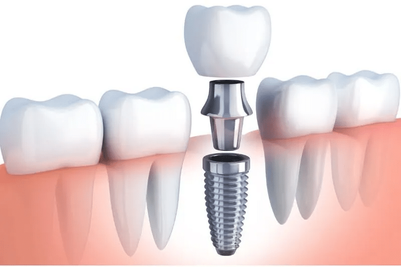 Full Set of Teeth 2