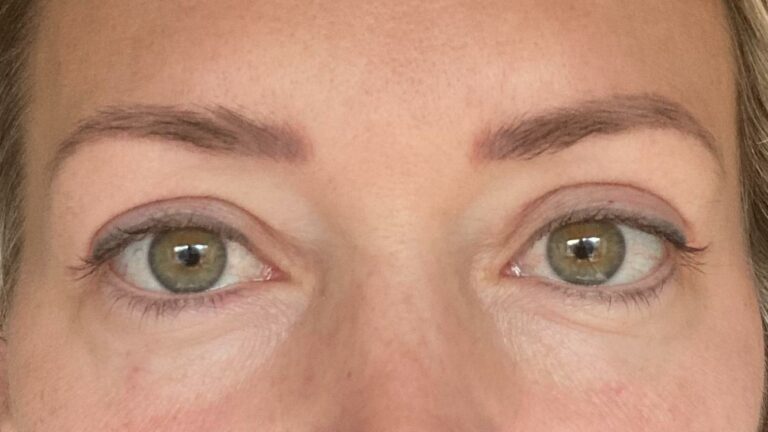 Reflect Clinic Highlights Upper Blepharoplasty as a Popular Anti-Ageing Solution