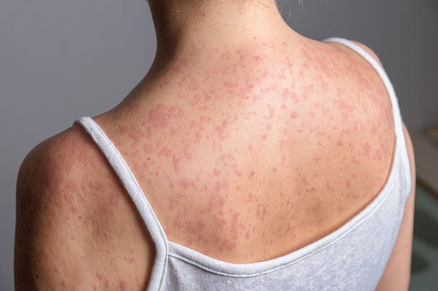 0 A woman with a red spotty rash caused by measles