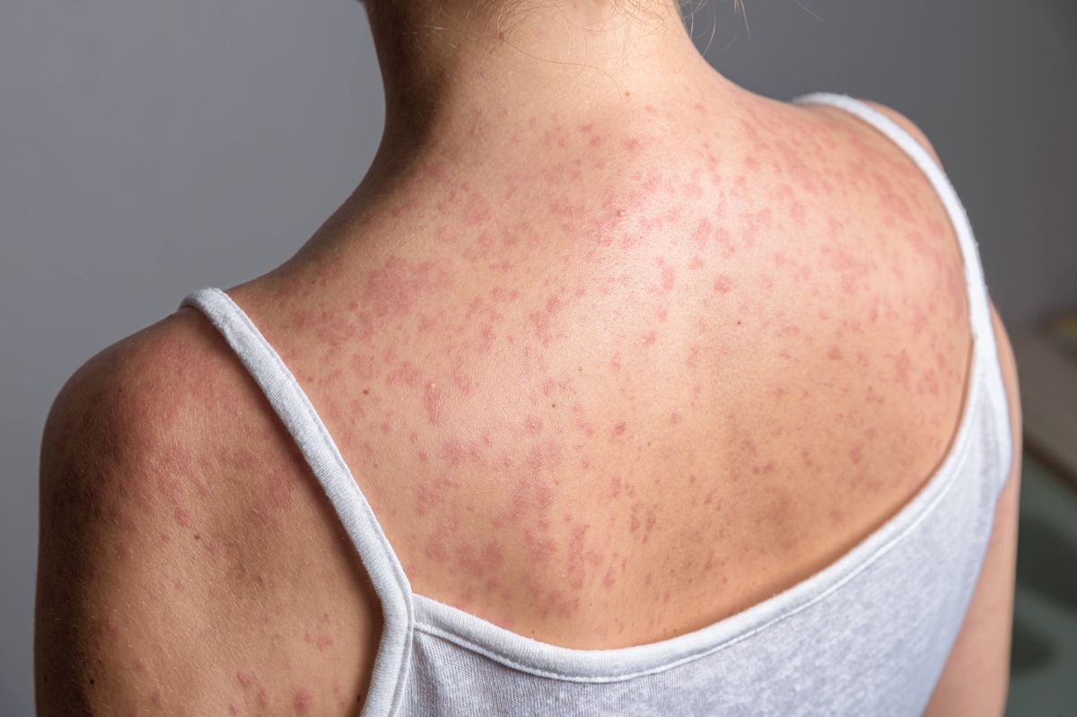 A woman with a red, spotty rash on her upper back and shoulders caused by measles.